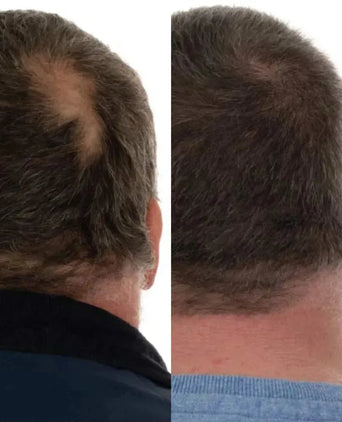 Foligain shampoo + conditioner voor mannen combinatiepakket