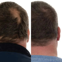 Foligain haargroei behandeling (man)