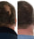 Foligain haargroei behandeling (man)
