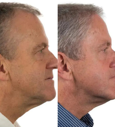 Foligain haargroei behandeling (man)