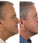 Foligain haargroei behandeling (man)