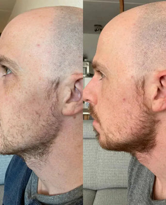 Neofollics baardgroei serum
