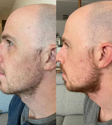 Neofollics baardgroei serum