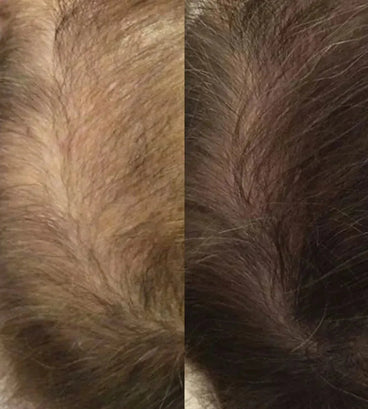 Neofollics haargroei lotion (7% Neoxyl)