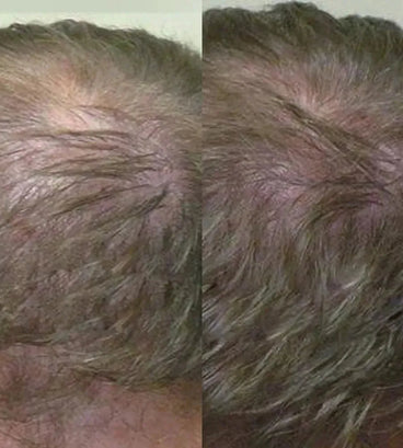 Neofollics haargroei shampoo (250 ml)