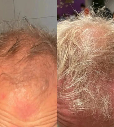 Neofollics haargroei shampoo (250 ml)