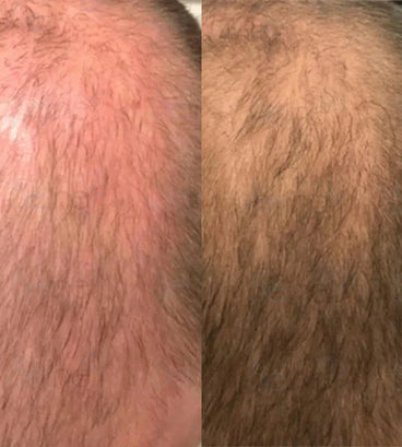 Panthrix haargroei serum (Redensyl)