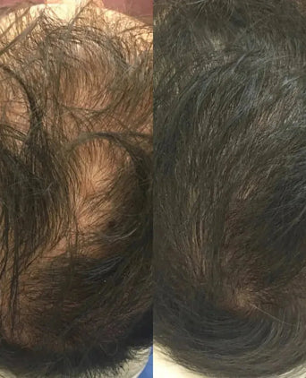 Revita haargroei shampoo + conditioner (925 ml)