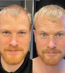 Scandinavian Biolabs haargroei behandeling (man)