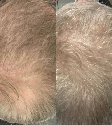 Scandinavian Biolabs haargroei behandeling (man)