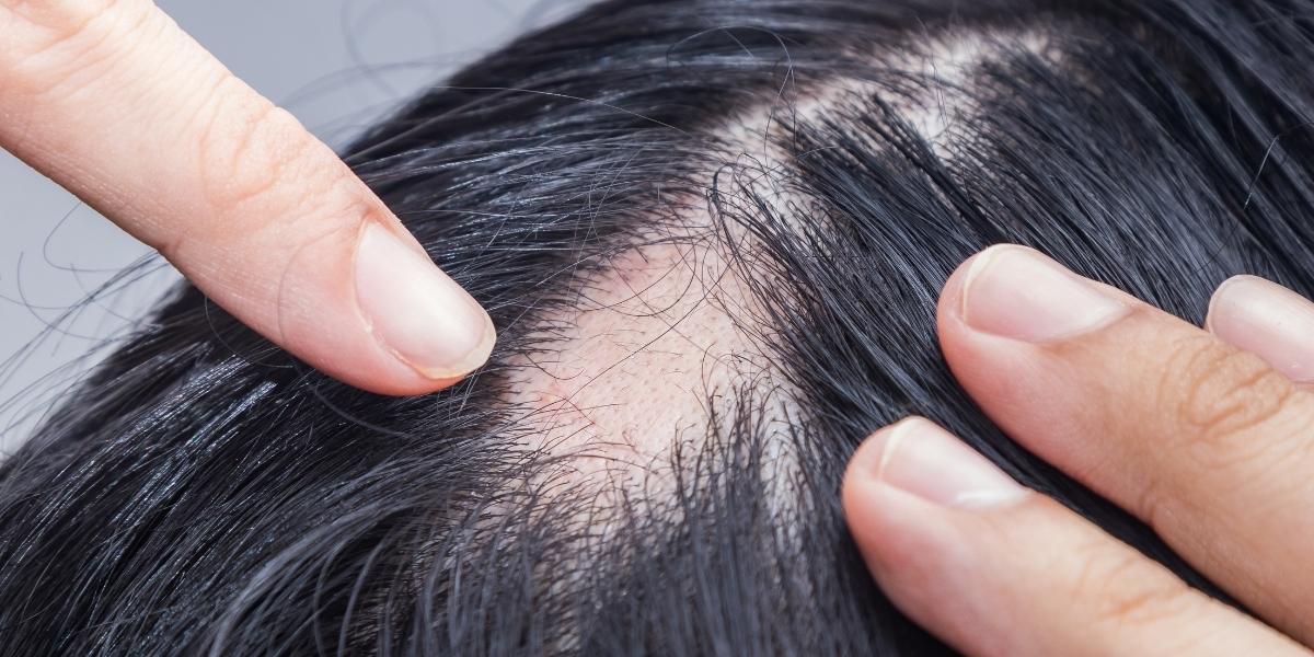 What is alopecia areata?