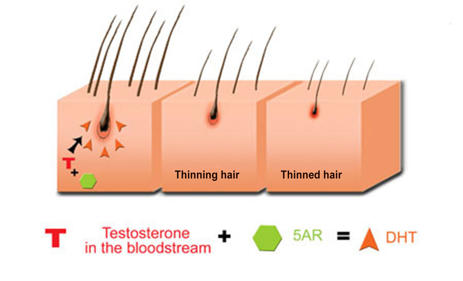 DHT: how does it cause hereditary hair loss? | The Hair Growth Specialist