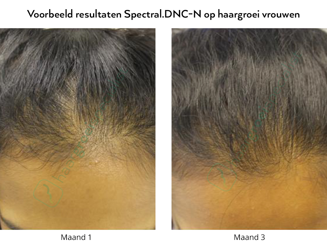 Voor en na foto's, erfelijk haarverlies vrouwen met Spectral.DNC-N Nanoxidil lotion