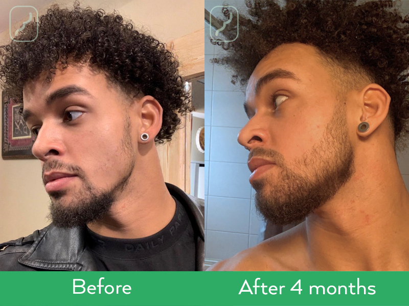 Neofollics beard growth serum before after results